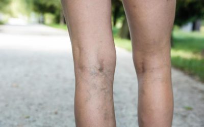 Varicosités des jambes